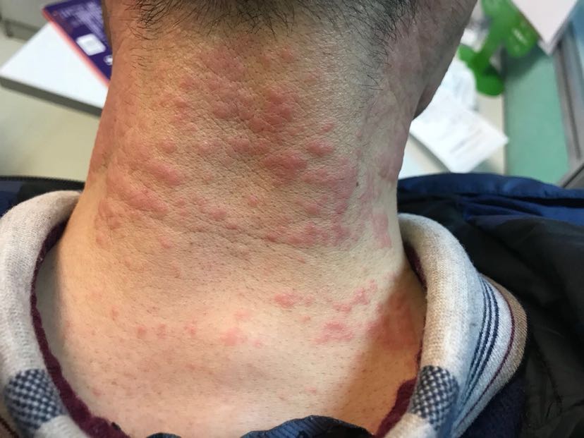 1、膏藥過敏怎么辦？