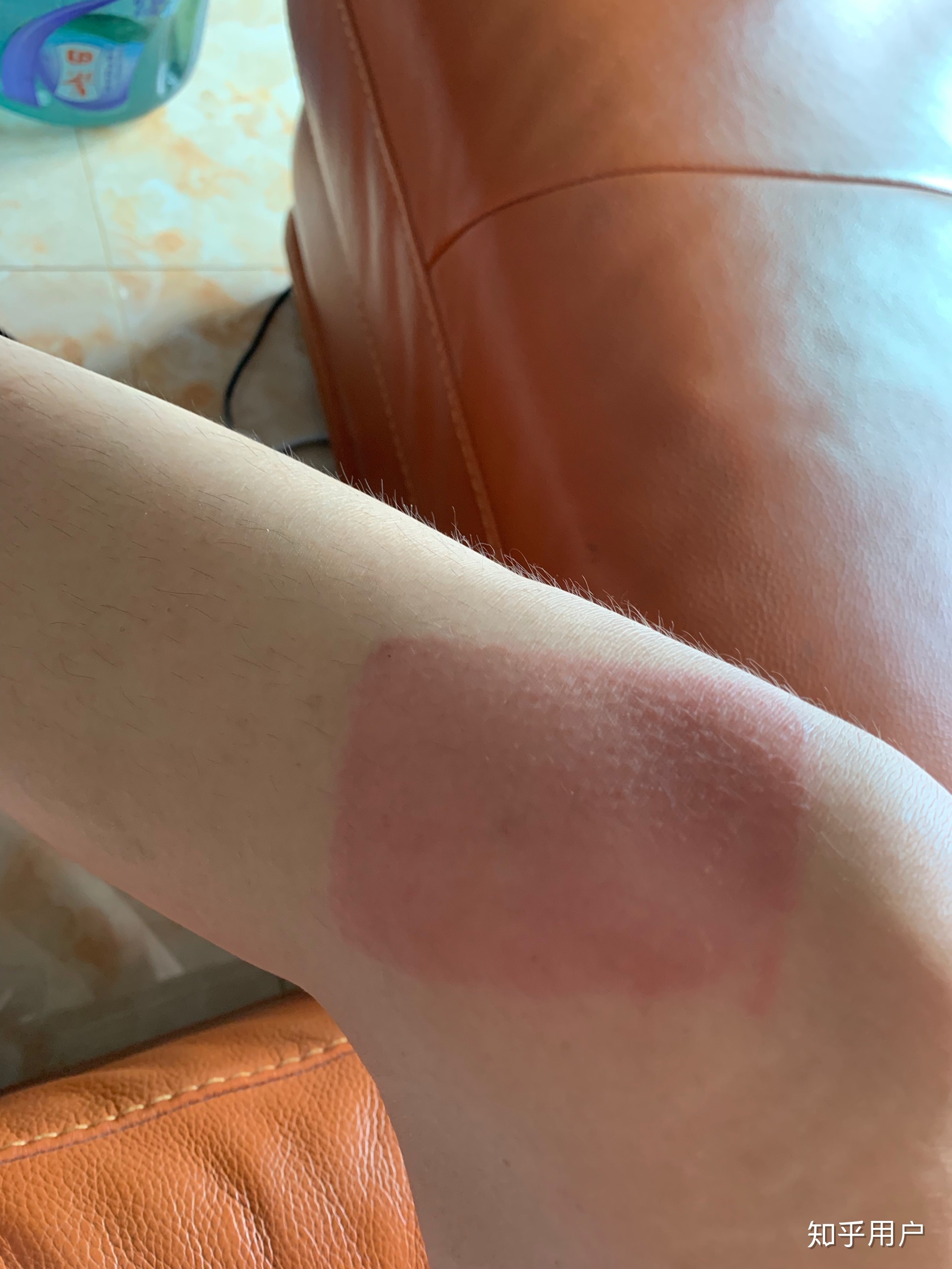 2、貼膏藥的地方有很多紅疙瘩，好不好？